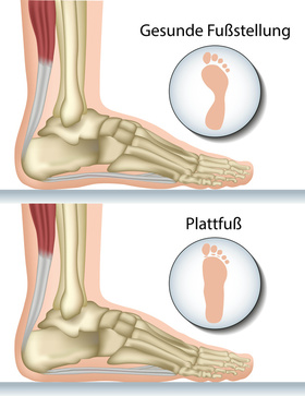 Schaubild zeigt gesunde Fußstellung und Plattfuß